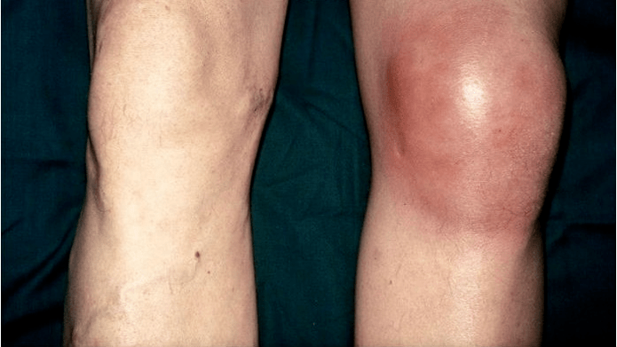 Arthroza in artritis